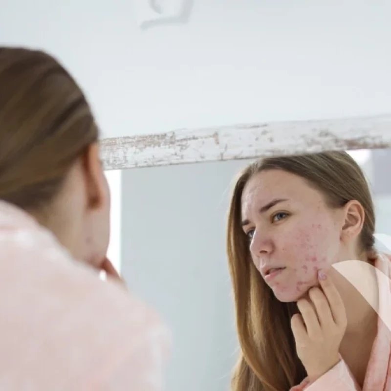 معلومات عليك معرفتها قبل البدء باستخدام دواء الروكتان (ROACCUTANE) / ايزوتريتينوين ( ISOTRETINOIN)